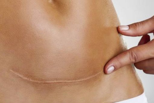 Scar tissue release post c-section, hip surgery, appendicitis removal.